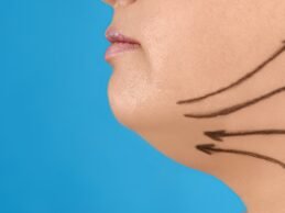 Lipopapada Quirúrgica