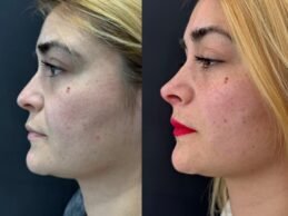 Rinomodelación con Ácido Hialurónico